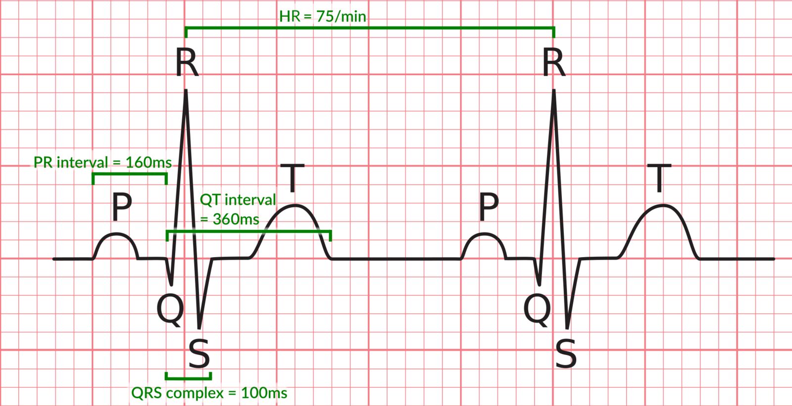 Qrs на экг